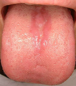 の 痛い が 舌 真ん中