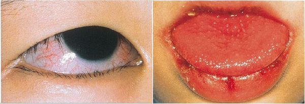 子供の高熱 目 唇が赤い 不機嫌は 川崎病 の疑い Medical Tribune