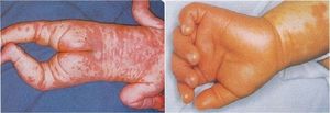 ⑤全身の発疹（左）、⑥手の紅斑<br>
（川崎病診断の手引き改訂5版より）