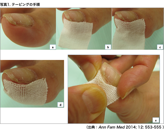 陥入爪はテーピングで治る 整形外科医のブログ