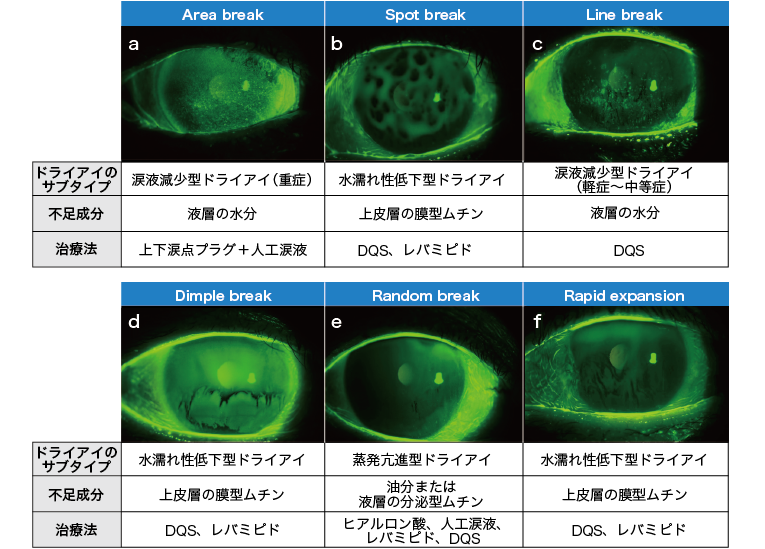 ドライアイ診断には眼表面の層別化が重要 眼 学会レポート 医療ニュース Medical Tribune