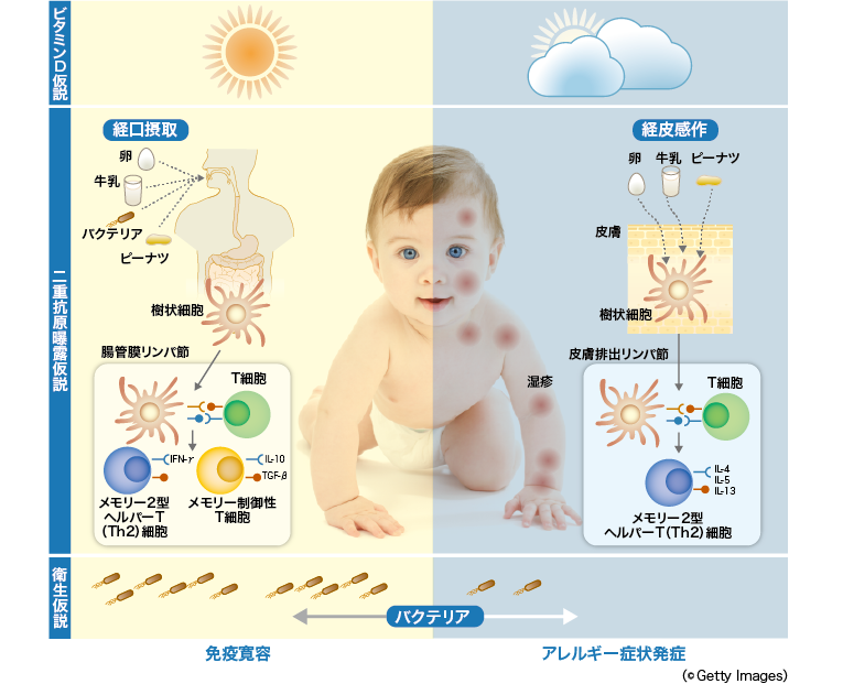 日光浴がアトピー性皮膚炎の発症予防に有効か 連載 特集 Medical Tribune